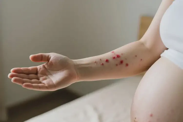 孕婦手臂出濕疹能靠自己自愈嗎(圖3)