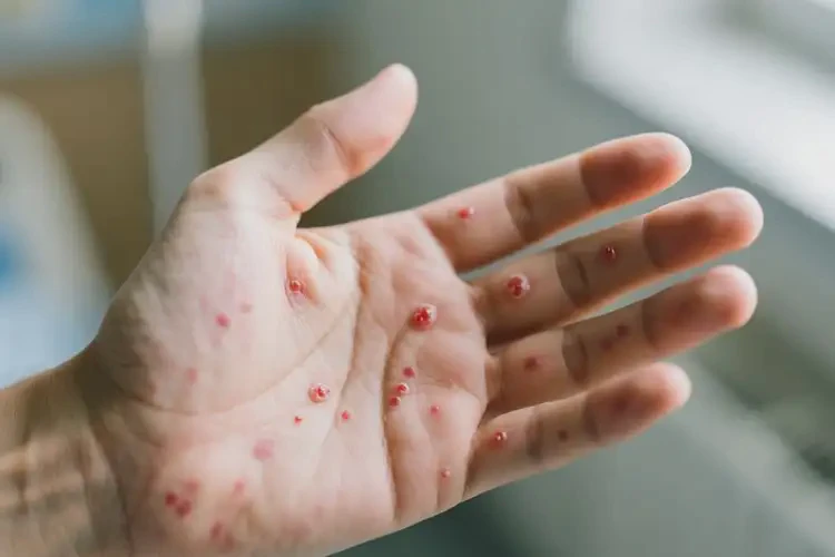 男生手上经常长湿疹不管它会自己好吗(图4)