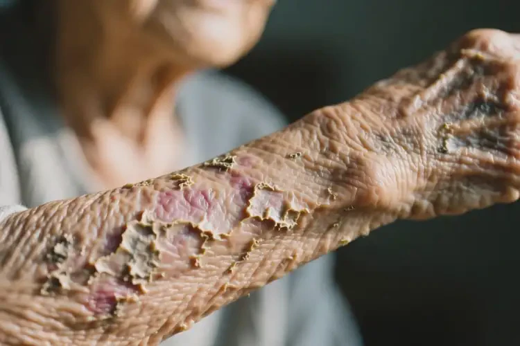 老年人手臂上經(jīng)常長濕疹不管它會(huì)自己痊愈嗎(圖2)