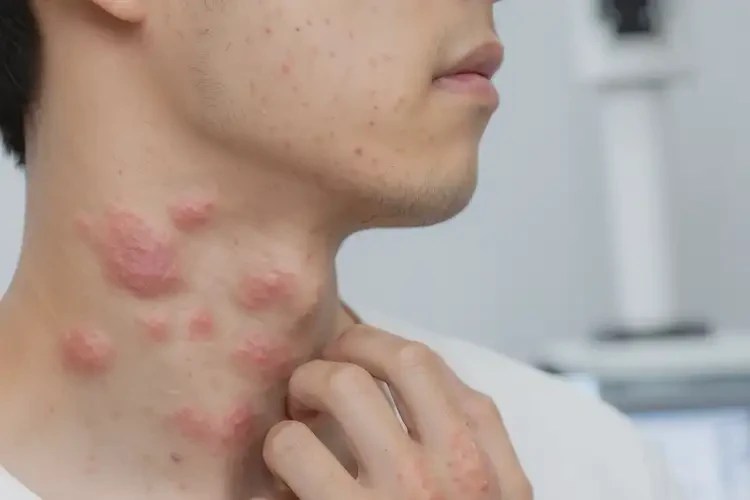 男生脖子經(jīng)常起濕疹不管它會自己好嗎(圖4)