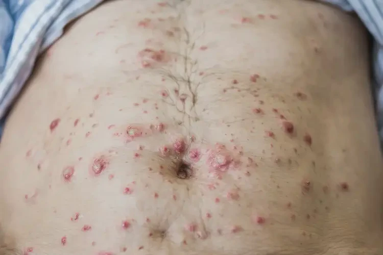 高齡老人肚子出濕疹可以徹底自愈嗎(圖4)