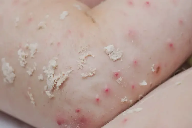 孩子全身容易起濕疹能徹底自愈嗎(圖4)