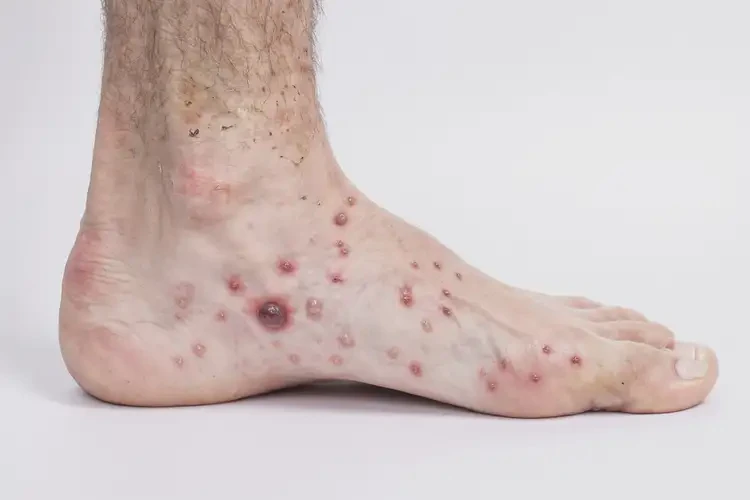 男性腳上偶爾長(zhǎng)濕疹不管它會(huì)自己痊愈嗎(圖3)