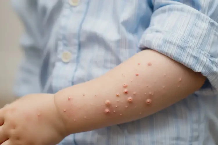 小兒手臂上容易起濕疹不管它會(huì)自己痊愈嗎(圖2)