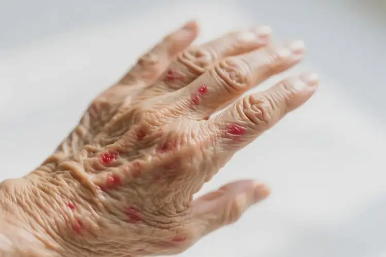 老年人四肢經(jīng)常起濕疹不管它會自己好嗎(圖4)