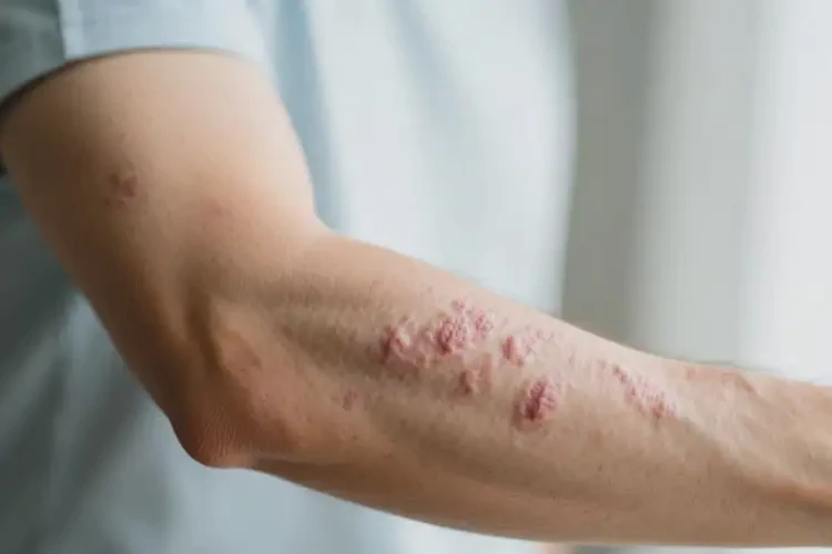 男人手臂容易起濕疹不管它會(huì)自己痊愈嗎(圖4)