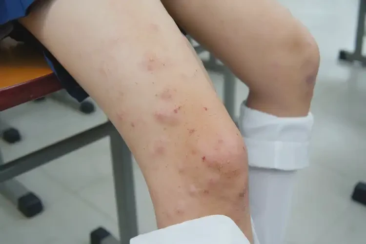 中學生小腿上出現(xiàn)濕疹可不可以徹底自愈(圖4)