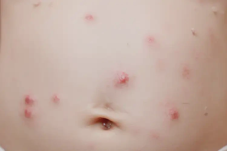 新生兒肚子有濕疹不管它會自己自愈嗎(圖4)