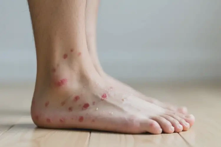 男人腳上經(jīng)常長(zhǎng)濕疹可不可以徹底自愈(圖2)