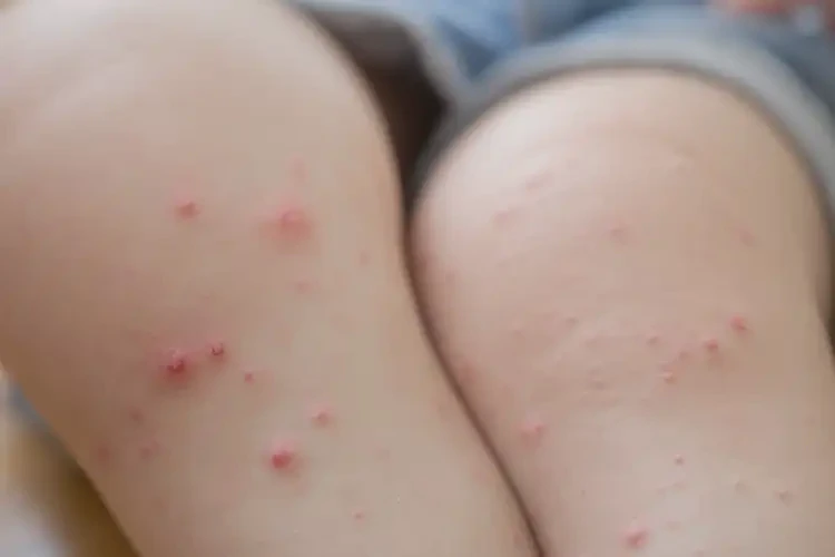 少兒小腿經(jīng)常長濕疹能靠自己自愈嗎(圖4)