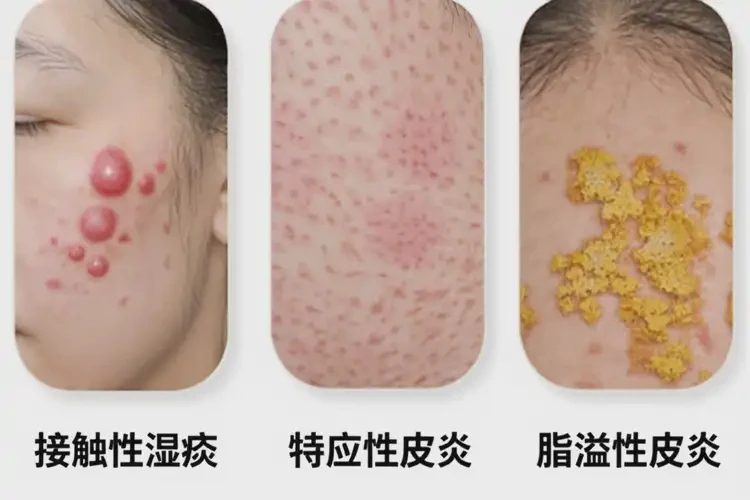 大學(xué)生肚子出現(xiàn)濕疹可不可以徹底自愈(圖3)