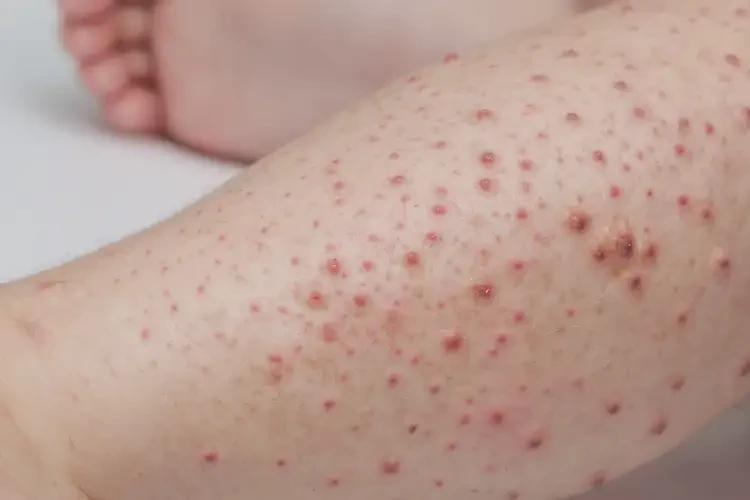 兒童四肢出濕疹能靠自己自愈嗎(圖4)