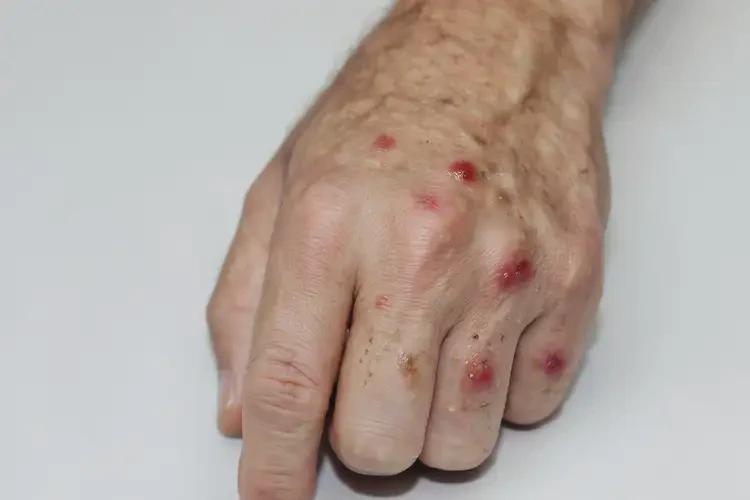 大學(xué)生手上出現(xiàn)濕疹不管它會(huì)自己痊愈嗎(圖2)