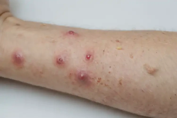 小孩身上偶爾起濕疹能徹底自愈嗎(圖2)