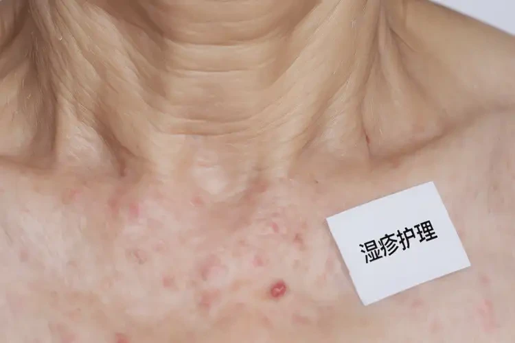 女性脖子上偶爾長濕疹不管它會自己好嗎(圖4)