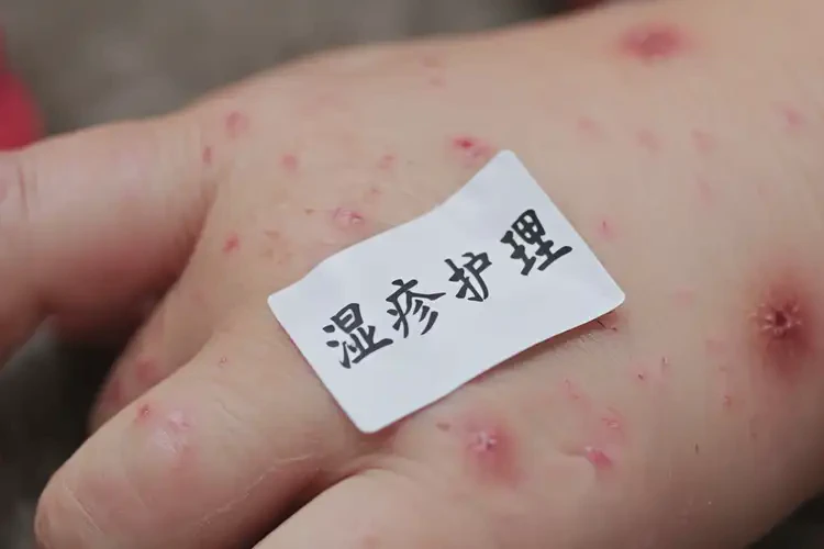 小兒手上偶爾長濕疹不管它會自己自愈嗎(圖4)
