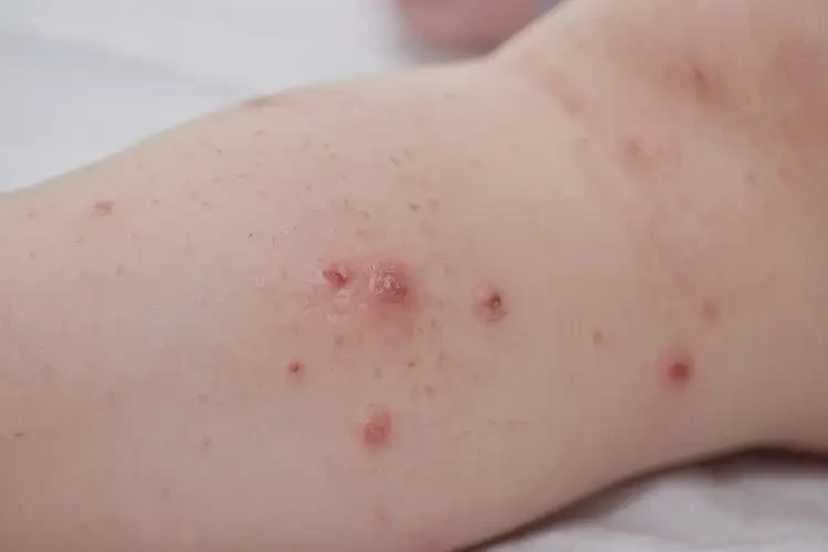 寶寶大腿上出現(xiàn)濕疹不管它會自己痊愈嗎(圖4)