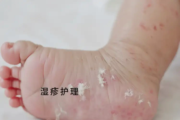 嬰兒腳上經(jīng)常長濕疹能靠自己自愈嗎(圖4)