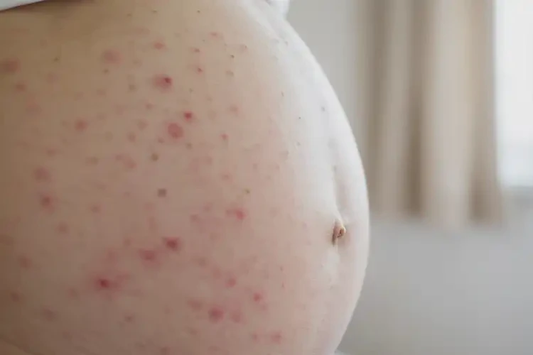 孕婦身上容易起濕疹不管它會(huì)自己自愈嗎(圖4)