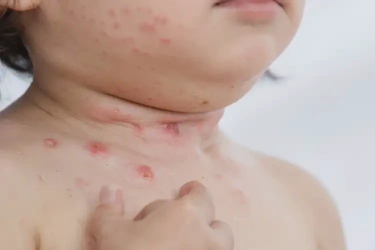 少兒脖子出現(xiàn)濕疹可以徹底自愈嗎(圖4)