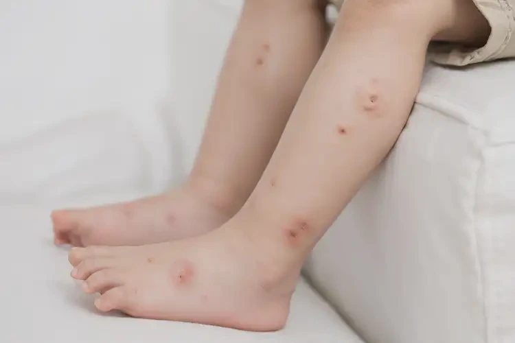 小儿小腿上偶尔长湿疹能靠自己自愈吗(图3)