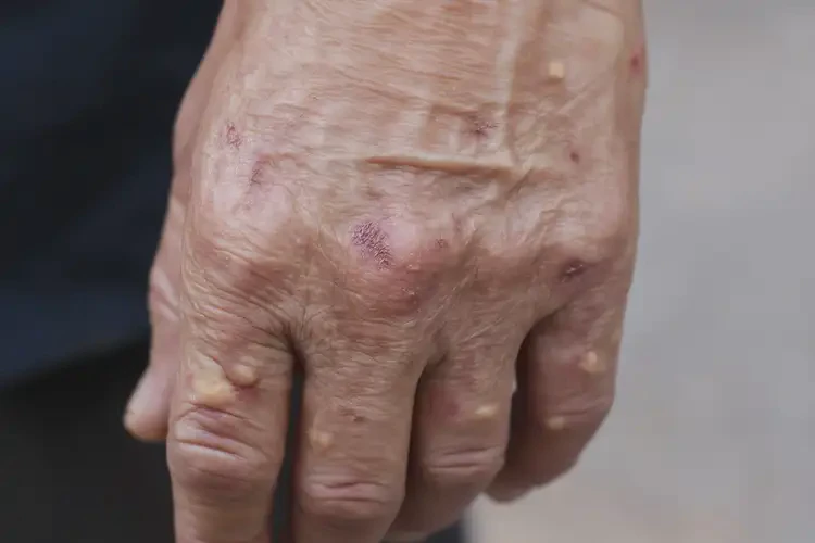 高齡老人手上經(jīng)常長濕疹能夠徹底治愈嗎(圖4)