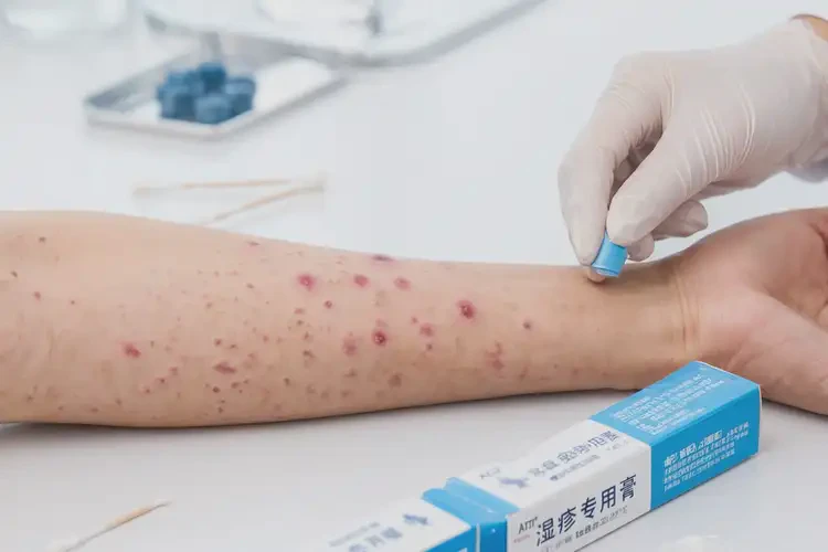 大學(xué)生屁股容易起濕疹可不可以徹底自愈(圖3)