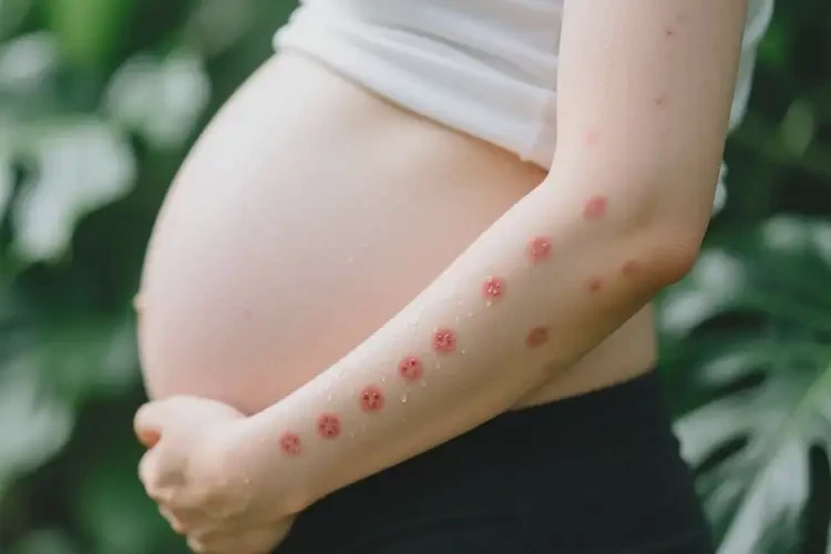 孕婦手臂出濕疹能靠自己自愈嗎(圖2)