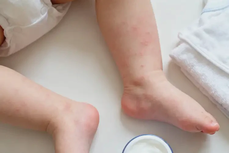 幼兒四肢有濕疹可不可以徹底自愈(圖4)