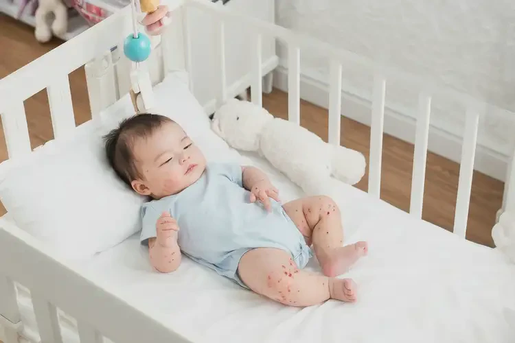 嬰幼兒四肢經(jīng)常長(zhǎng)濕疹不管它會(huì)自己痊愈嗎(圖3)