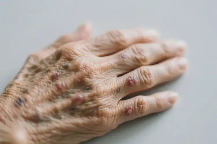 老年人手上偶爾長濕疹能靠自己自愈嗎(圖2)