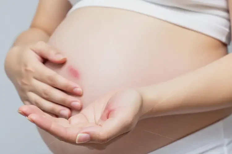 產(chǎn)婦手臂上起濕疹能夠徹底治愈嗎(圖4)