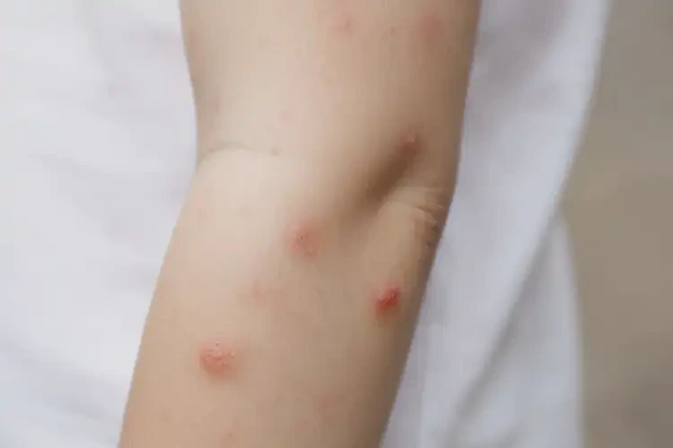 兒童手臂上容易長濕疹能夠徹底治愈嗎(圖4)