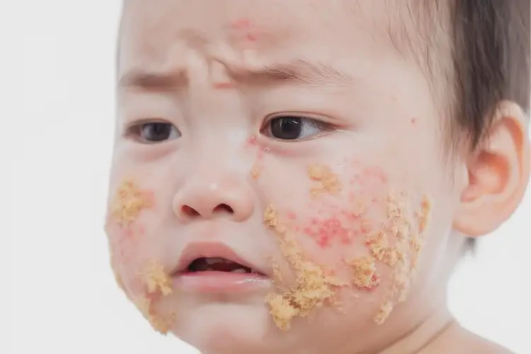 少兒手臂出濕疹能靠自己自愈嗎(圖3)