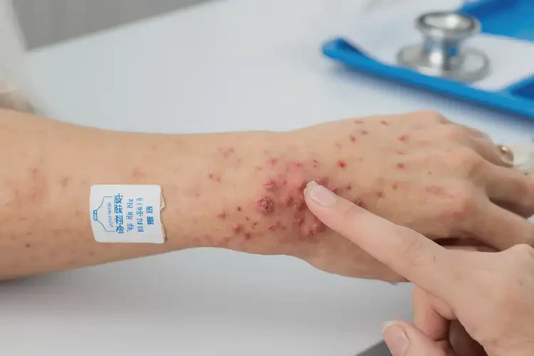 女人手臂起濕疹可不可以徹底自愈(圖3)