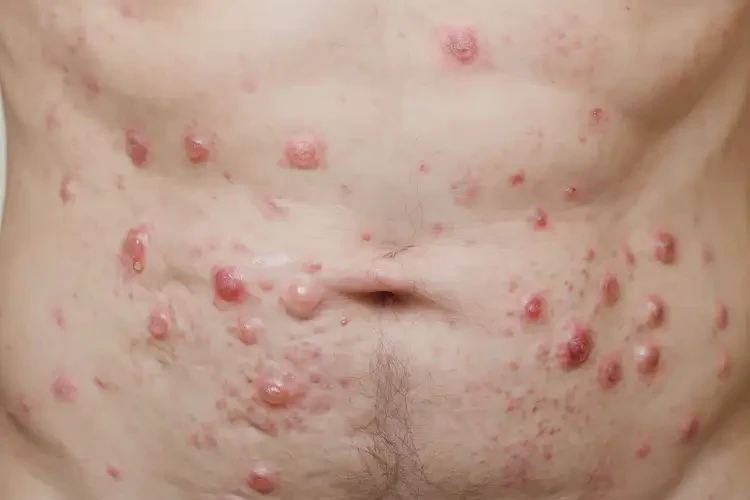 男性肚子上容易長濕疹可不可以徹底自愈(圖4)