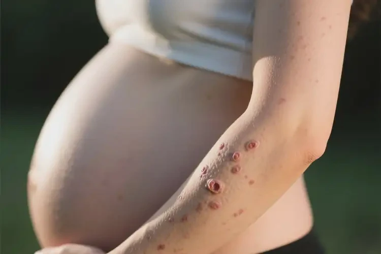 孕婦手臂出濕疹不管它會(huì)自己自愈嗎(圖3)