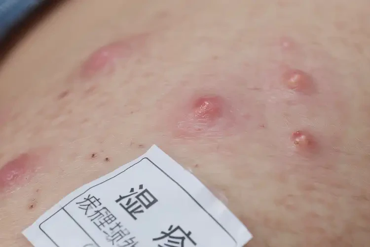 青少年肛周容易長濕疹能不能徹底自愈(圖4)