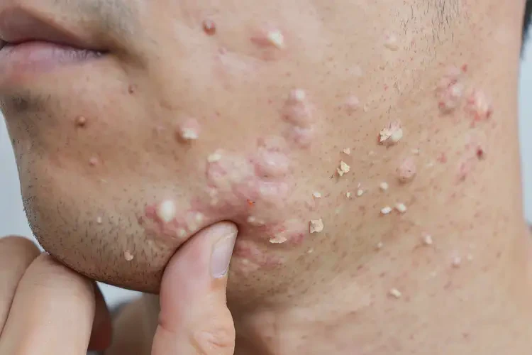 青年人脖子起濕疹能徹底自愈嗎(圖4)