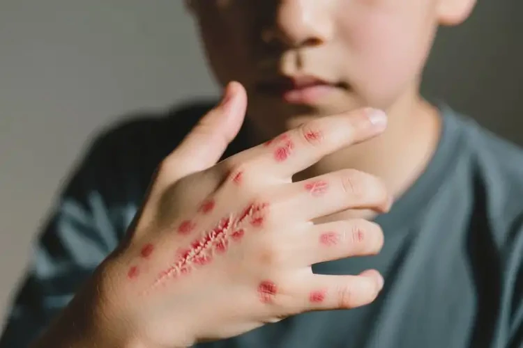 青年人手上起濕疹不管它會自己自愈嗎(圖2)