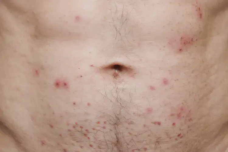 男人肚子上長濕疹能徹底自愈嗎(圖4)