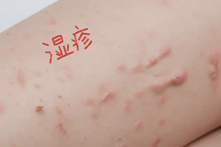 兒童大腿上容易長(zhǎng)濕疹不管它會(huì)自己痊愈嗎(圖4)