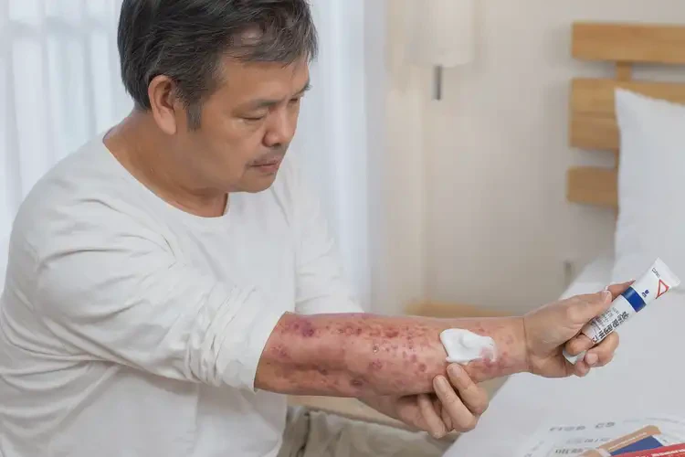 女人腳上經(jīng)常起濕疹不管它會(huì)自己自愈嗎(圖2)