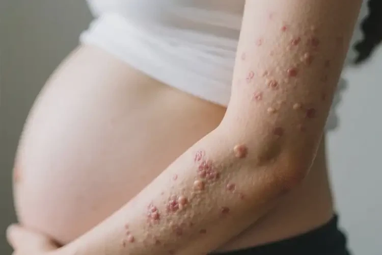 孕婦手臂出濕疹不管它會(huì)自己自愈嗎(圖1)