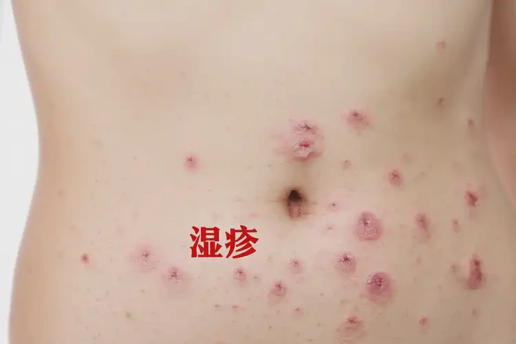 女性肚子上容易起濕疹可不可以徹底自愈(圖4)