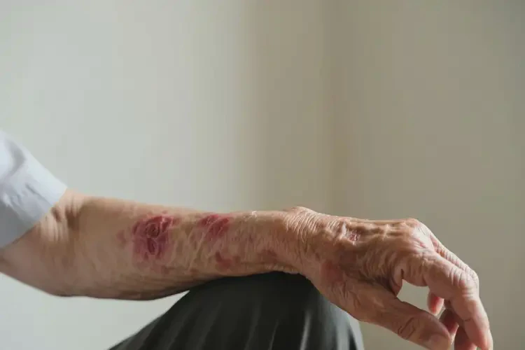 老人手臂上有濕疹不管它會自己痊愈嗎(圖4)