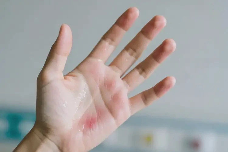 青少年手上經(jīng)常起濕疹不管它會自己自愈嗎(圖2)