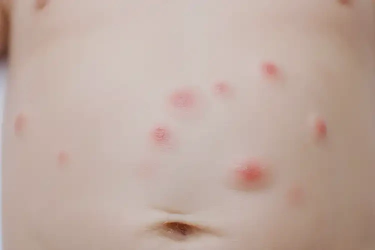 幼兒肚子經(jīng)常長(zhǎng)濕疹不管它會(huì)自己自愈嗎(圖4)