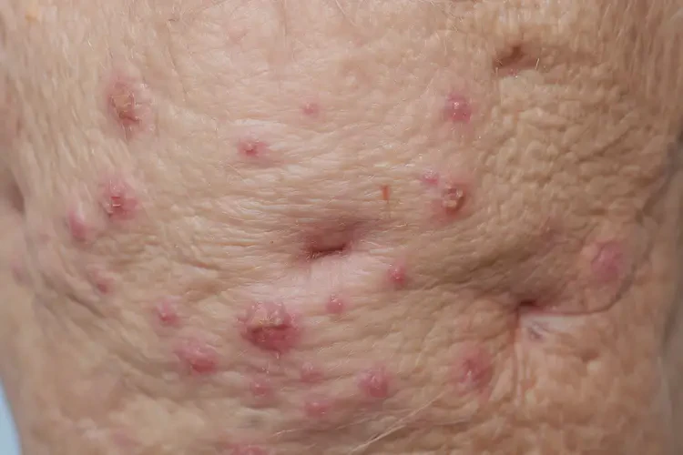 老年人肛周長濕疹不管它會自己好嗎(圖4)