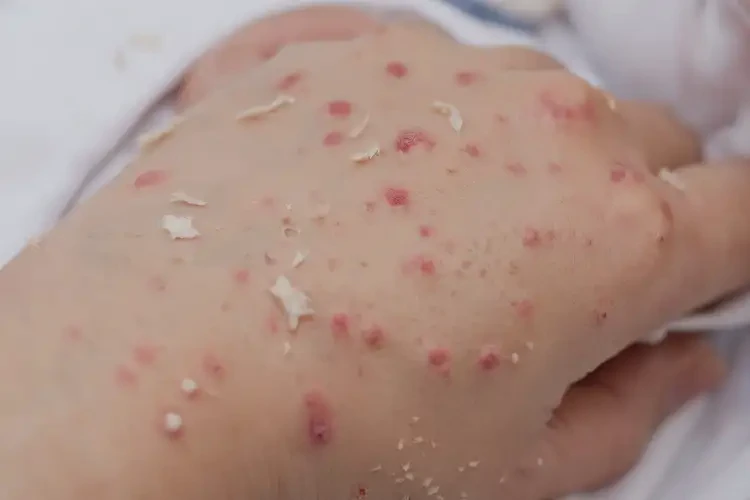 產(chǎn)婦手上出濕疹不管它會自己痊愈嗎(圖4)